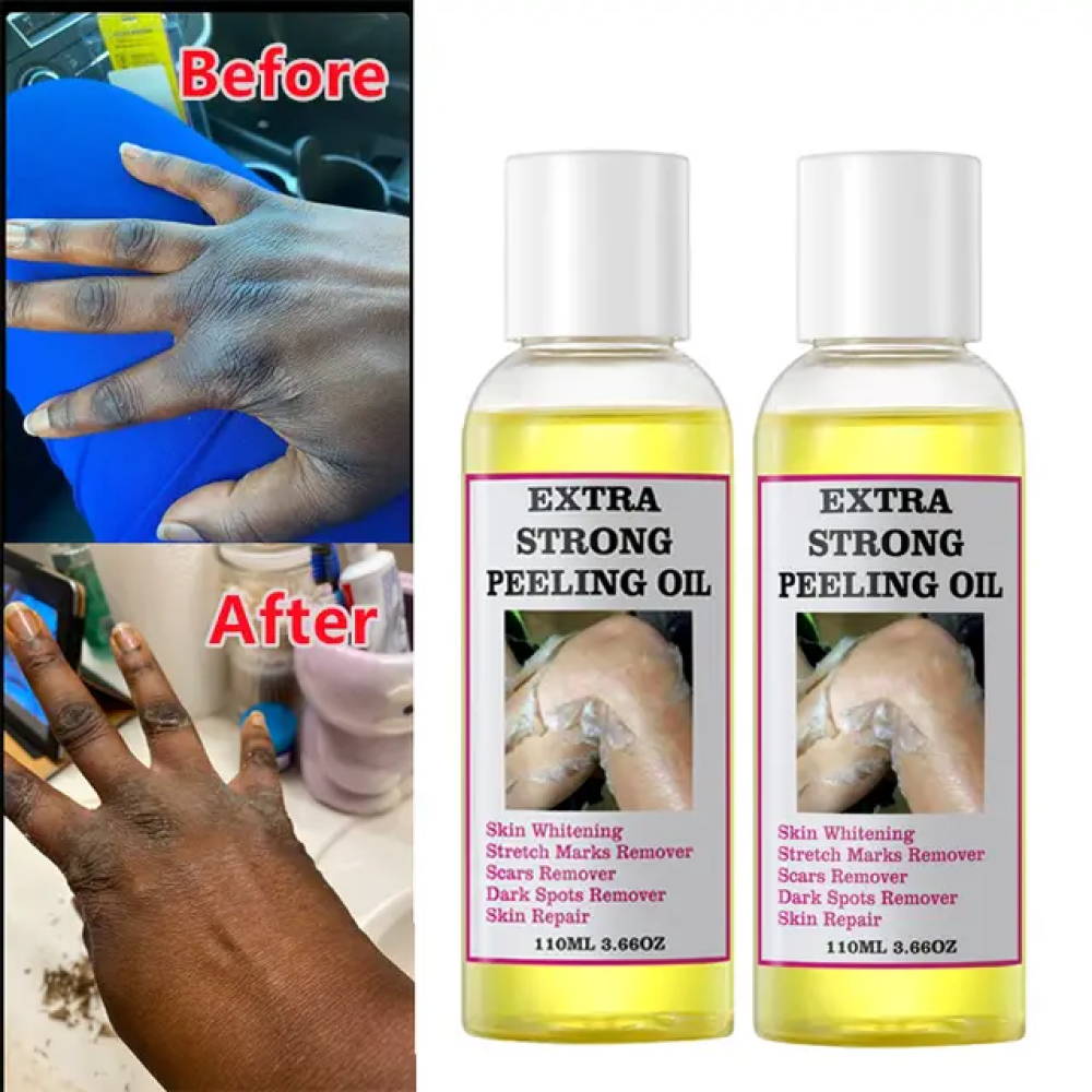 Extra Strong Peeling Oil, Stretch Mark Exfoliating Solution Whitening Oil, Skin Whitening, Stretch Marks Remover, Scar Remover