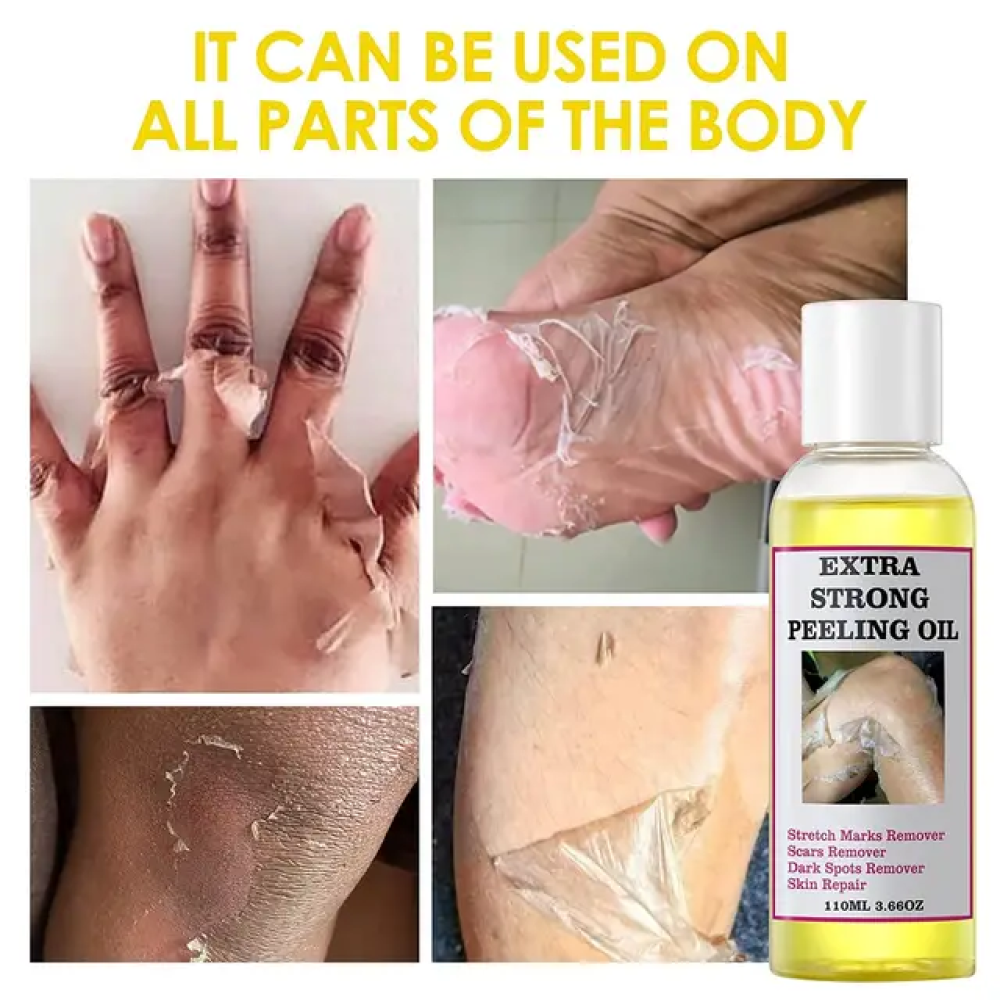 Extra Strong Peeling Oil, Stretch Mark Exfoliating Solution Whitening Oil, Skin Whitening, Stretch Marks Remover, Scar Remover