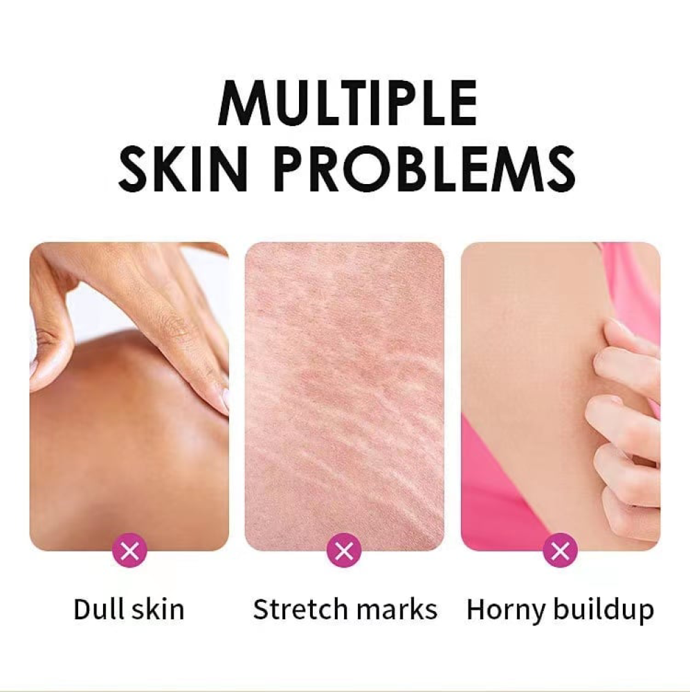 Extra Strong Peeling Oil, Stretch Mark Exfoliating Solution Whitening Oil, Skin Whitening, Stretch Marks Remover, Scar Remover