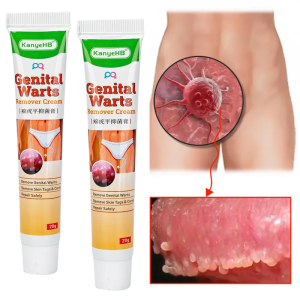 KanyeHB Wart Removal Cream Vulva Anus Genital Herpes Warts Special Ointment Human Papilloma Virus Herbal Ointment