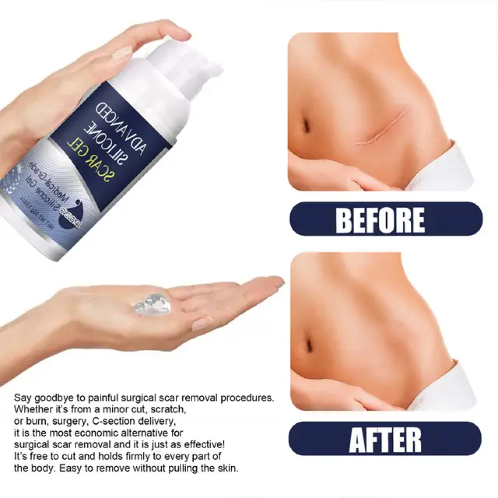 Jaysuing Advanced Silicone Scar Gel for Surgical Scars | C-Section & Stretch Mark Remover, Old & New Scar Management